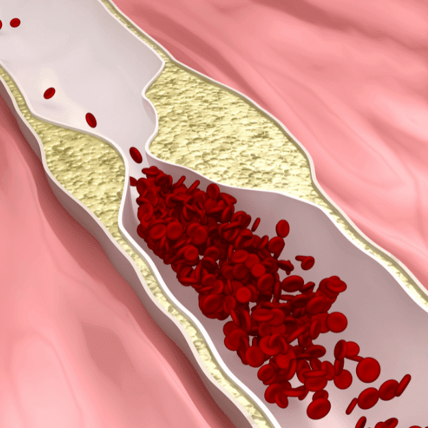 A CGI of a clogged artery to question whether animal fat causes arterial disease